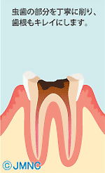虫歯の部分を丁寧に削り、歯根もキレイにします。