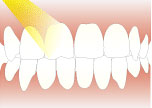 歯のホワイトニング